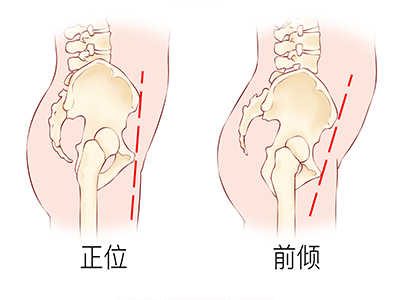 骨盆前倾该如何矫正 如何矫正骨盆前倾