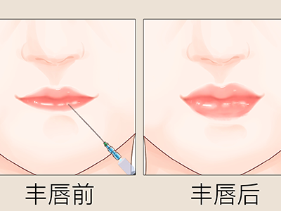 玻尿酸多少钱一针 玻尿酸是什么