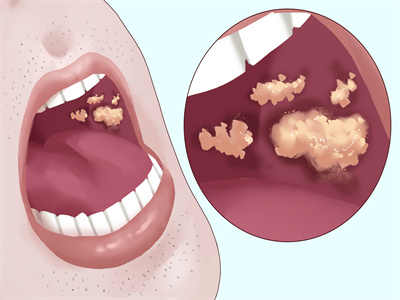 经常口腔溃疡是怎么回事 口腔溃疡的注意事项