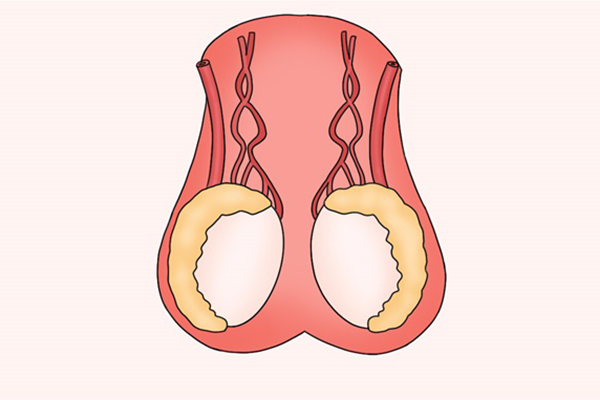 睾丸坠痛是怎么回事?
